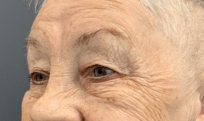 Blepharoplasty Before & After Gallery - Patient 355328 - Image 7