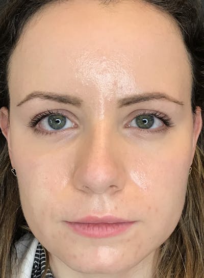 Dermal Fillers Before & After Gallery - Patient 210414 - Image 2