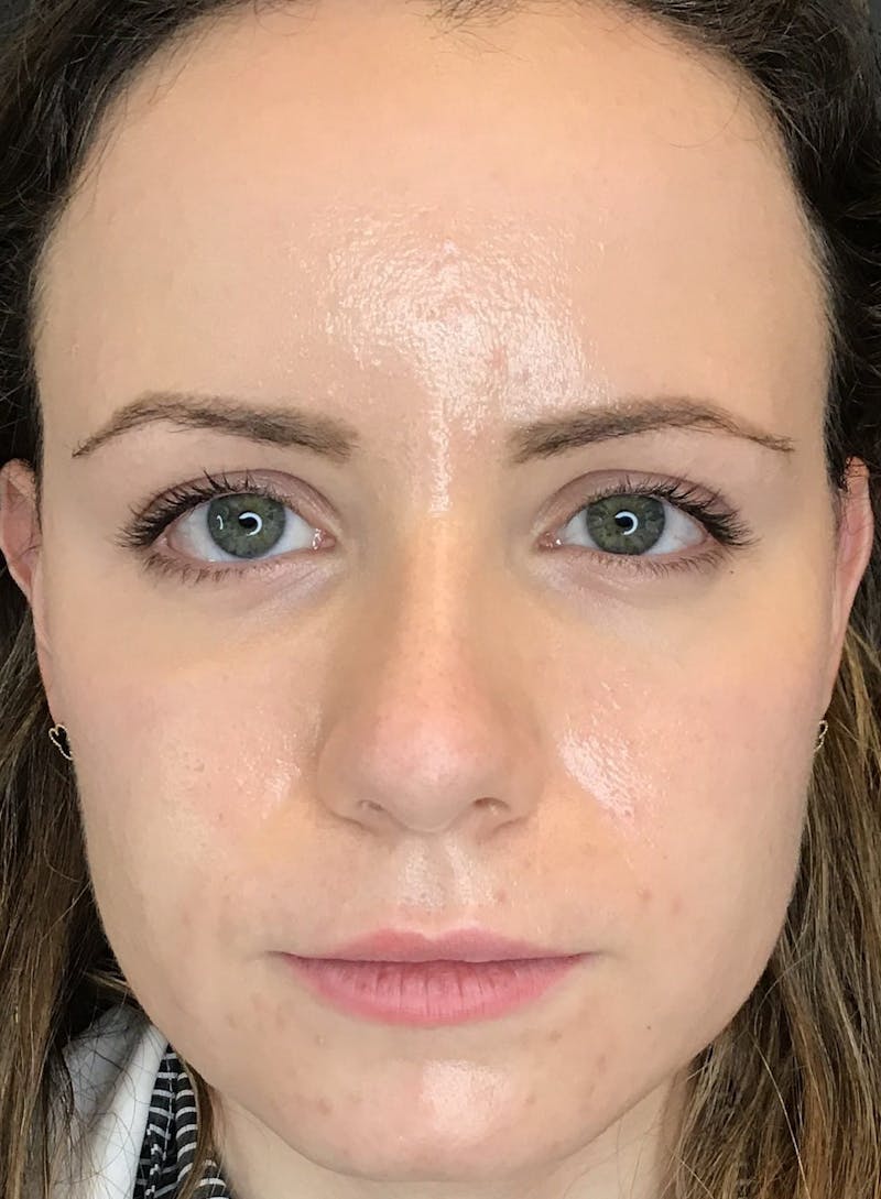Dermal Fillers Before & After Gallery - Patient 210414 - Image 2