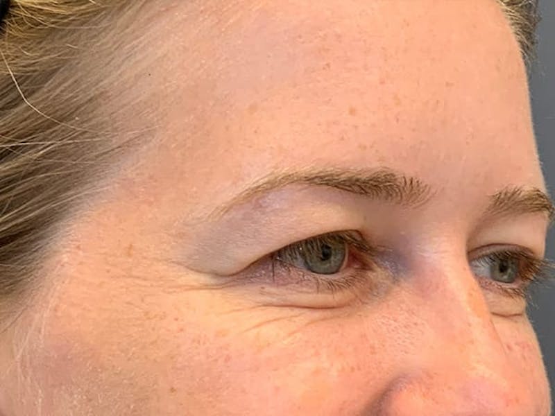 Botox Before & After Gallery - Patient 945116 - Image 7