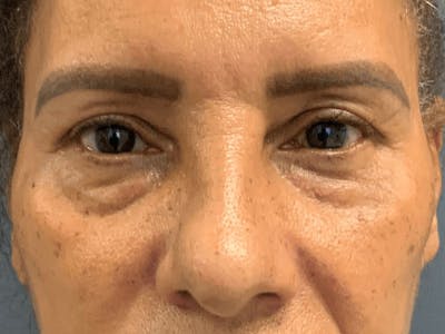 Blepharoplasty Before & After Gallery - Patient 276694 - Image 1