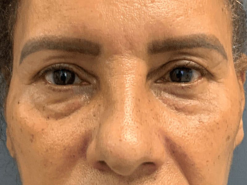 Blepharoplasty Before & After Gallery - Patient 276694 - Image 1
