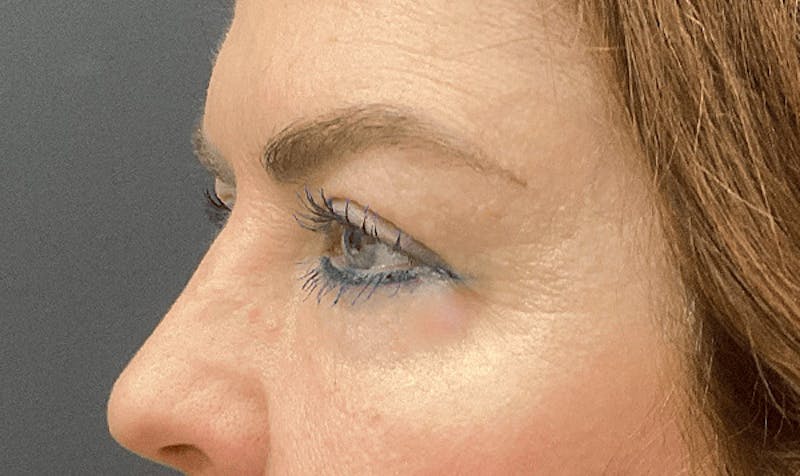 Blepharoplasty Before & After Gallery - Patient 127507 - Image 4