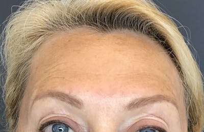 Botox Before & After Gallery - Patient 415012 - Image 2