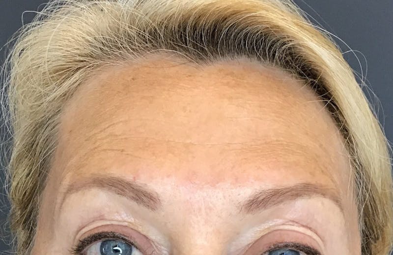 Botox Before & After Gallery - Patient 415012 - Image 2