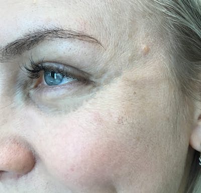 Botox Before & After Gallery - Patient 362280 - Image 2