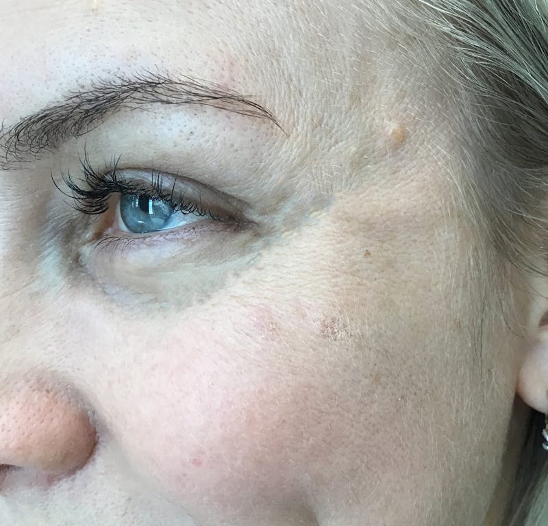 Botox Before & After Gallery - Patient 362280 - Image 2