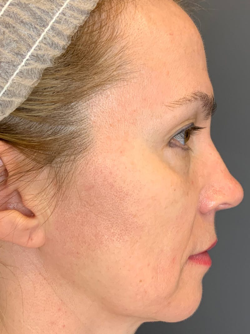 Dermal Fillers Before & After Gallery - Patient 402126 - Image 7