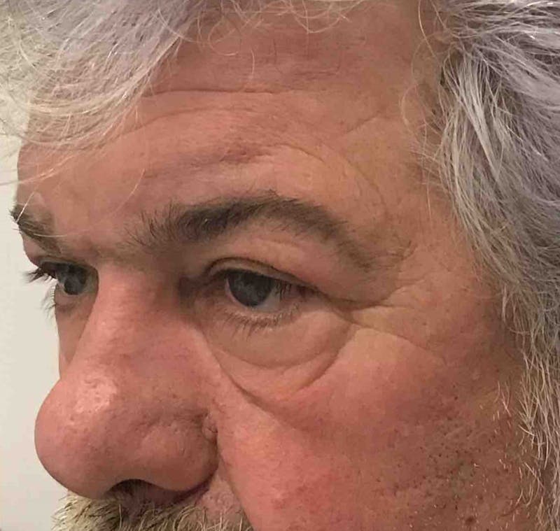Blepharoplasty Before & After Gallery - Patient 254621 - Image 4