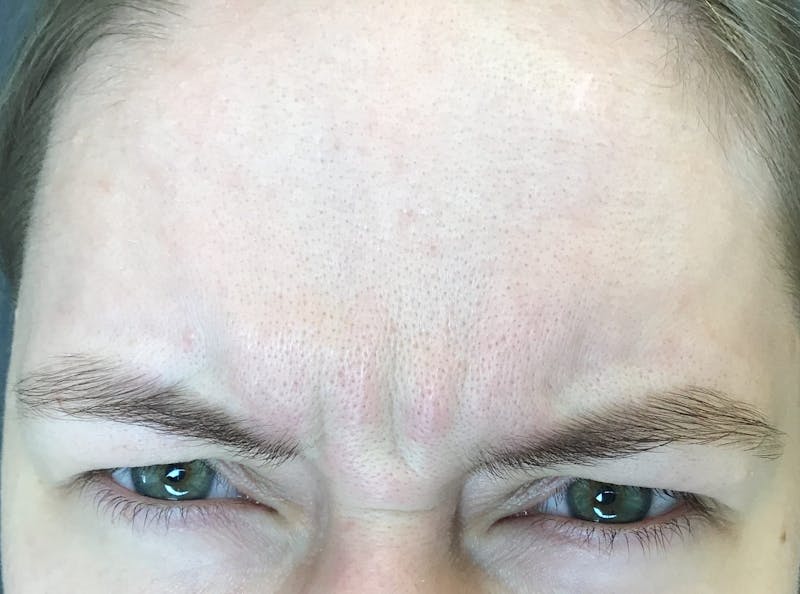Botox Before & After Gallery - Patient 381345 - Image 1