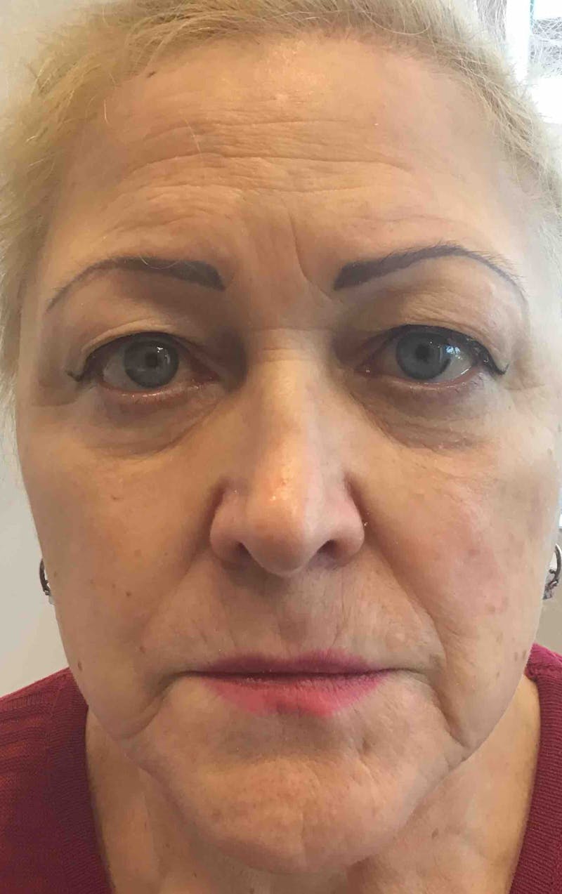 Dermal Fillers Before & After Gallery - Patient 100588 - Image 1