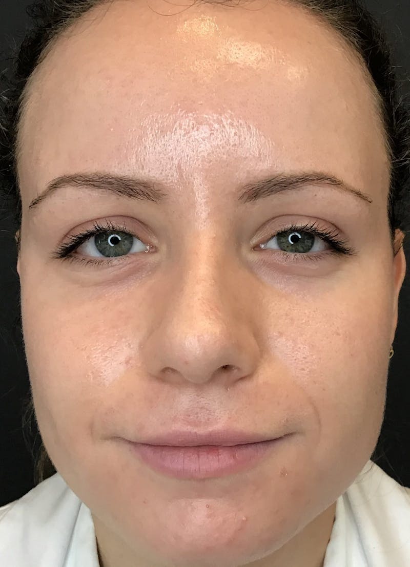 Dermal Fillers Before & After Gallery - Patient 210414 - Image 1