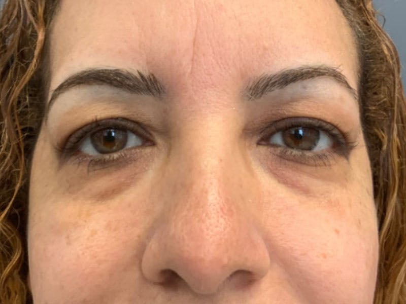 Blepharoplasty Before & After Gallery - Patient 246857 - Image 1