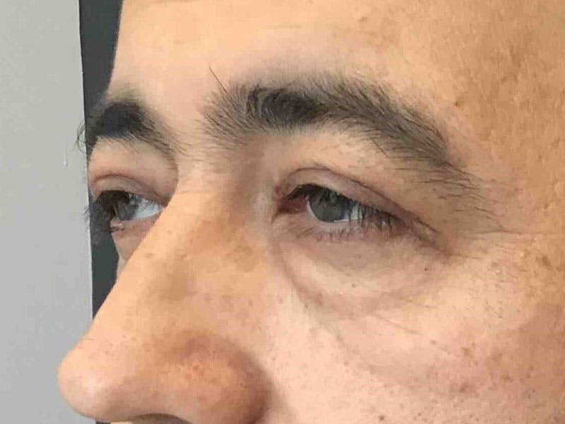 Blepharoplasty Before & After Gallery - Patient 228529 - Image 2