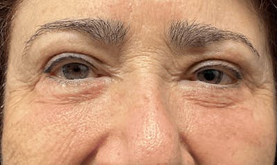 Blepharoplasty Before & After Gallery - Patient 867382 - Image 2