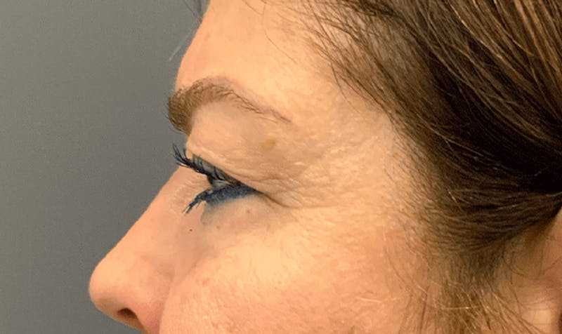 Blepharoplasty Before & After Gallery - Patient 127507 - Image 3