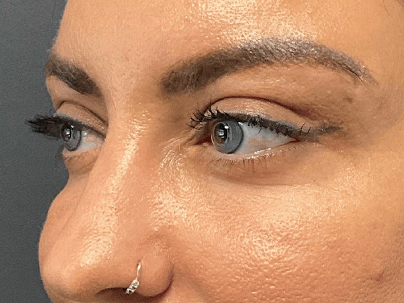 Blepharoplasty Before & After Gallery - Patient 275170 - Image 6