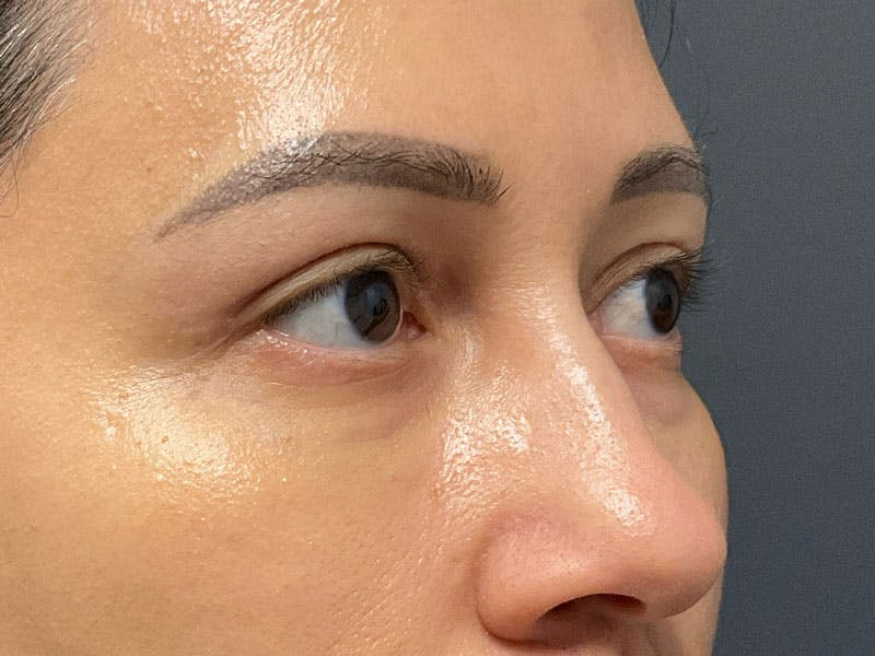 Blepharoplasty Before & After Gallery - Patient 410588 - Image 4