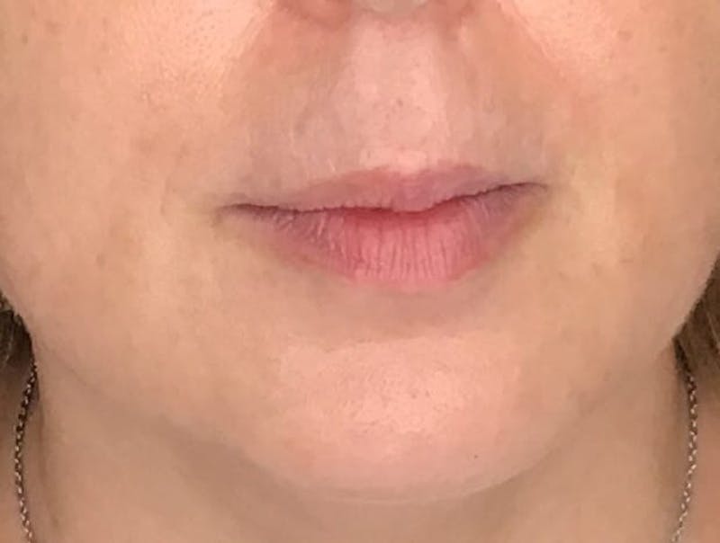 Dermal Fillers Before & After Gallery - Patient 172972 - Image 1