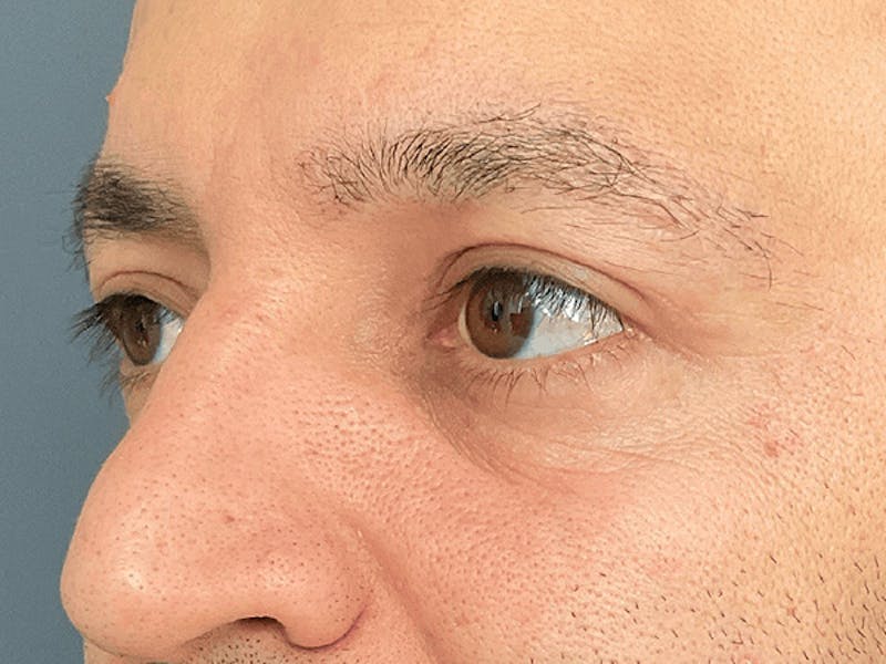 Blepharoplasty Before & After Gallery - Patient 278046 - Image 10