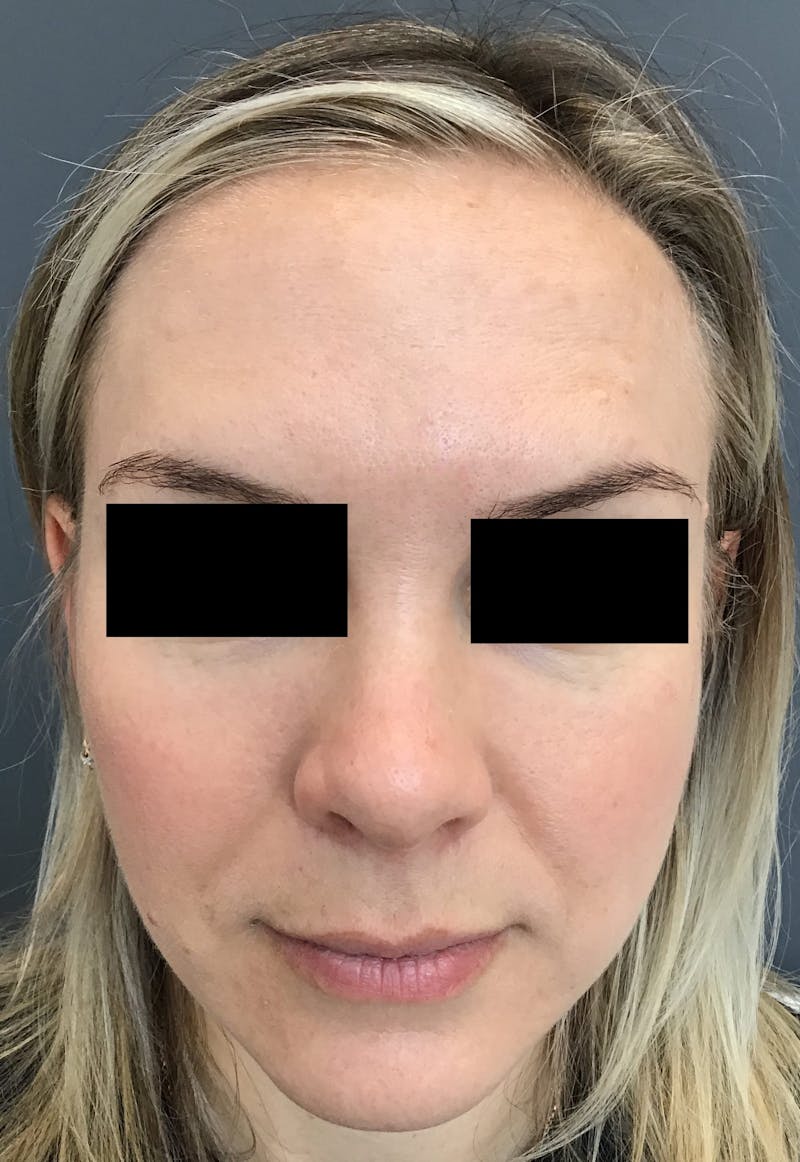 Botox Before & After Gallery - Patient 371778 - Image 2