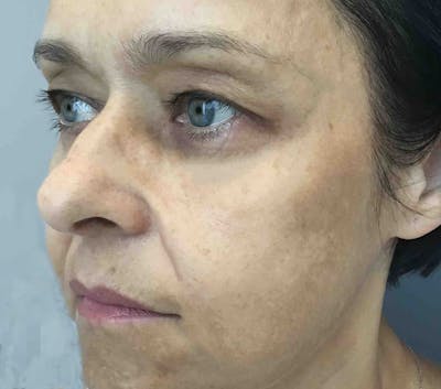 Dermal Fillers Before & After Gallery - Patient 854886 - Image 2