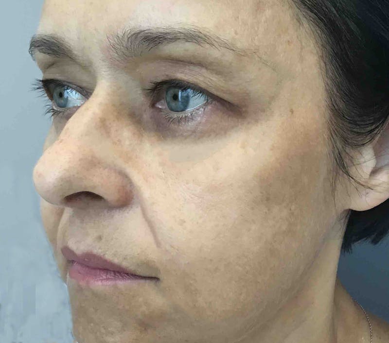 Dermal Fillers Before & After Gallery - Patient 854886 - Image 2