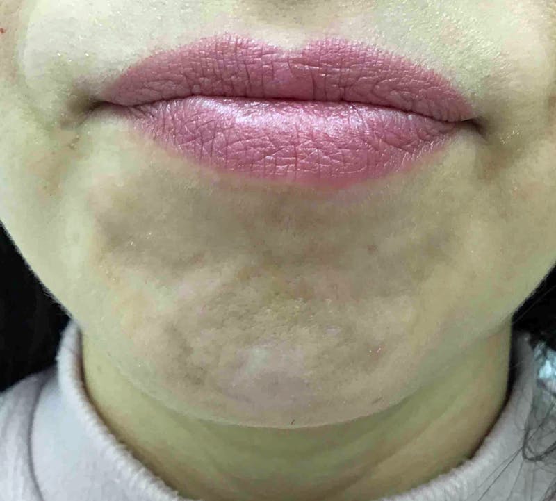 Botox Before & After Gallery - Patient 261799 - Image 1