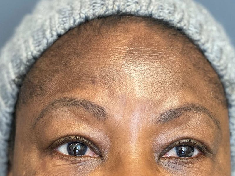Botox Before & After Gallery - Patient 303794 - Image 3