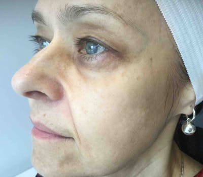 Dermal Fillers Before & After Gallery - Patient 854886 - Image 1