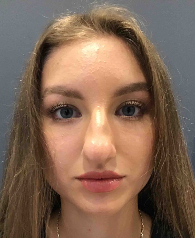 Dermal Fillers Before & After Gallery - Patient 846868 - Image 2