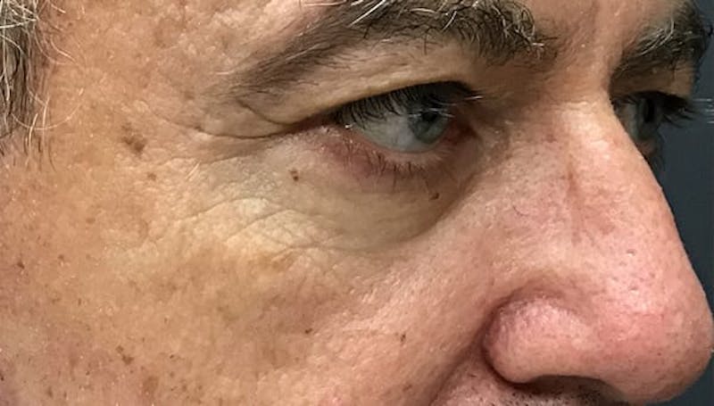 Blepharoplasty Before & After Gallery - Patient 380770 - Image 5