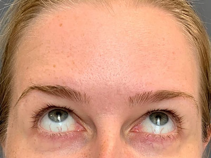 Botox Before & After Gallery - Patient 945116 - Image 4