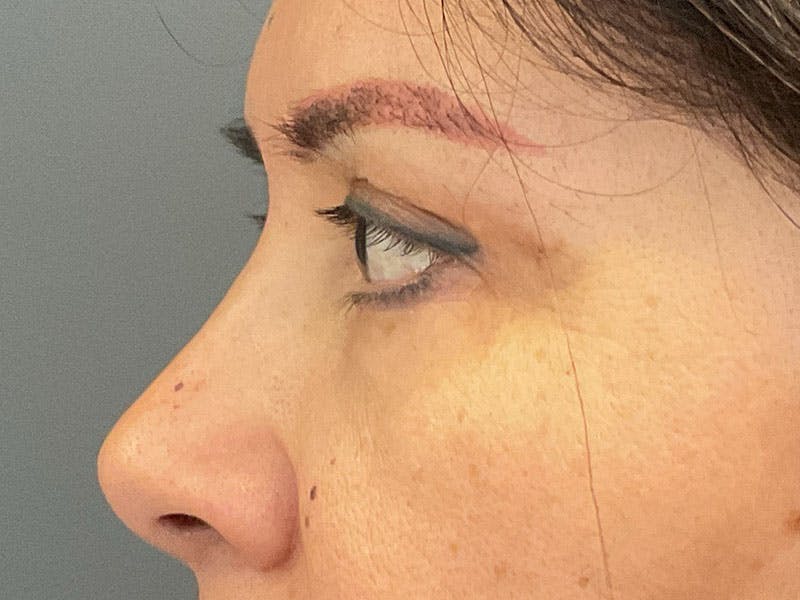 Blepharoplasty Before & After Gallery - Patient 341667 - Image 6