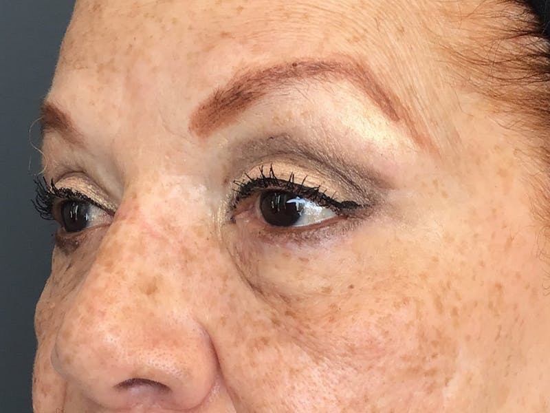 Blepharoplasty Before & After Gallery - Patient 460585 - Image 4