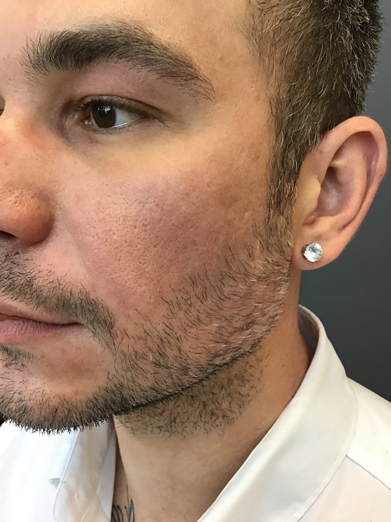 Dermal Fillers Before & After Gallery - Patient 559442 - Image 2