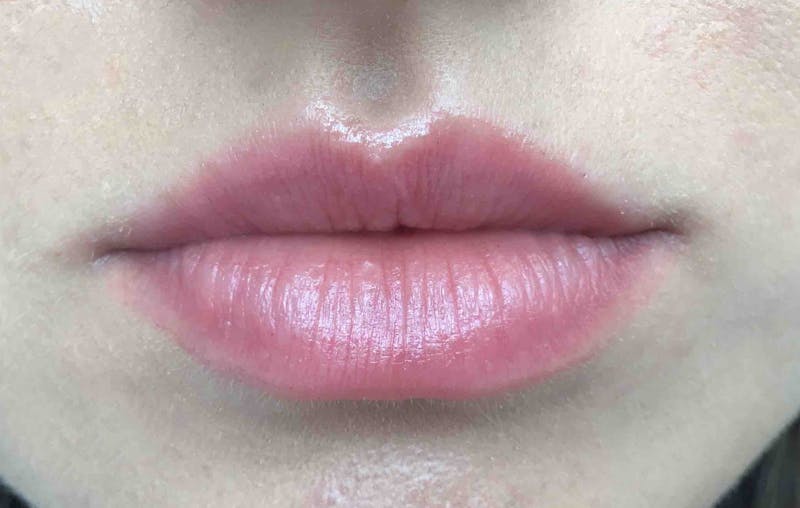 Dermal Fillers Before & After Gallery - Patient 280142 - Image 1