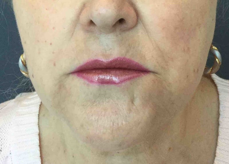 Dermal Fillers Before & After Gallery - Patient 176015 - Image 2