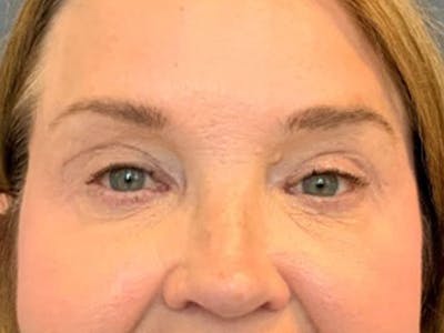 Blepharoplasty Before & After Gallery - Patient 290723 - Image 2