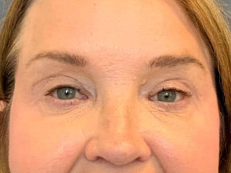 Blepharoplasty Before & After Gallery - Patient 290723 - Image 2