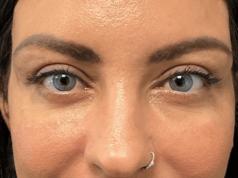 Blepharoplasty Before & After Gallery - Patient 275170 - Image 2
