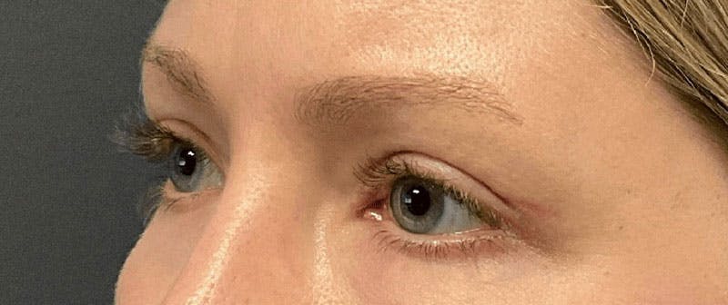 Blepharoplasty Before & After Gallery - Patient 732744 - Image 4