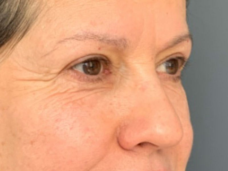 Blepharoplasty Before & After Gallery - Patient 289139 - Image 4