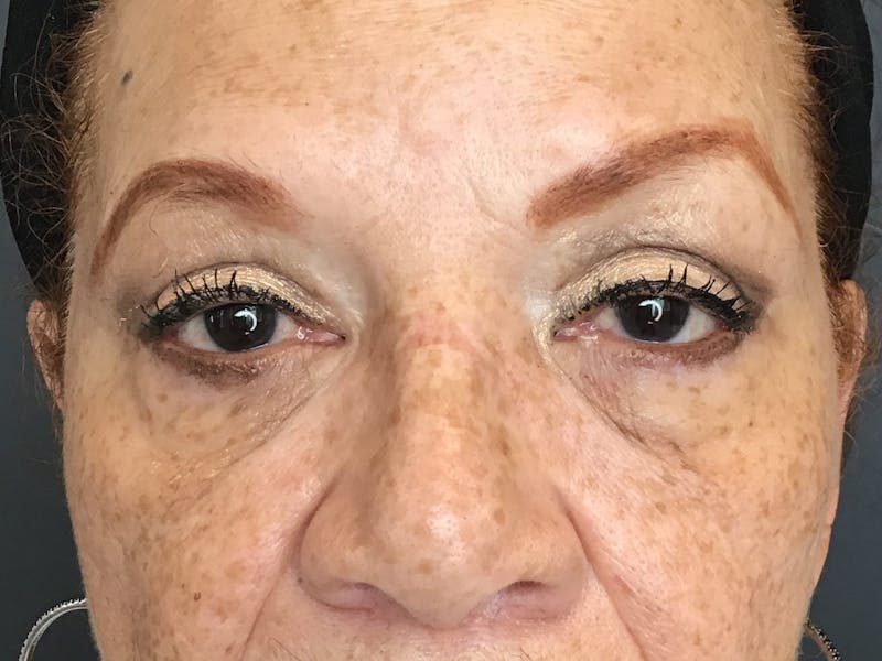 Blepharoplasty Before & After Gallery - Patient 460585 - Image 2
