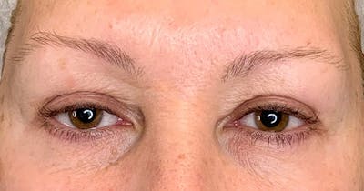 Botox Before & After Gallery - Patient 230320 - Image 2
