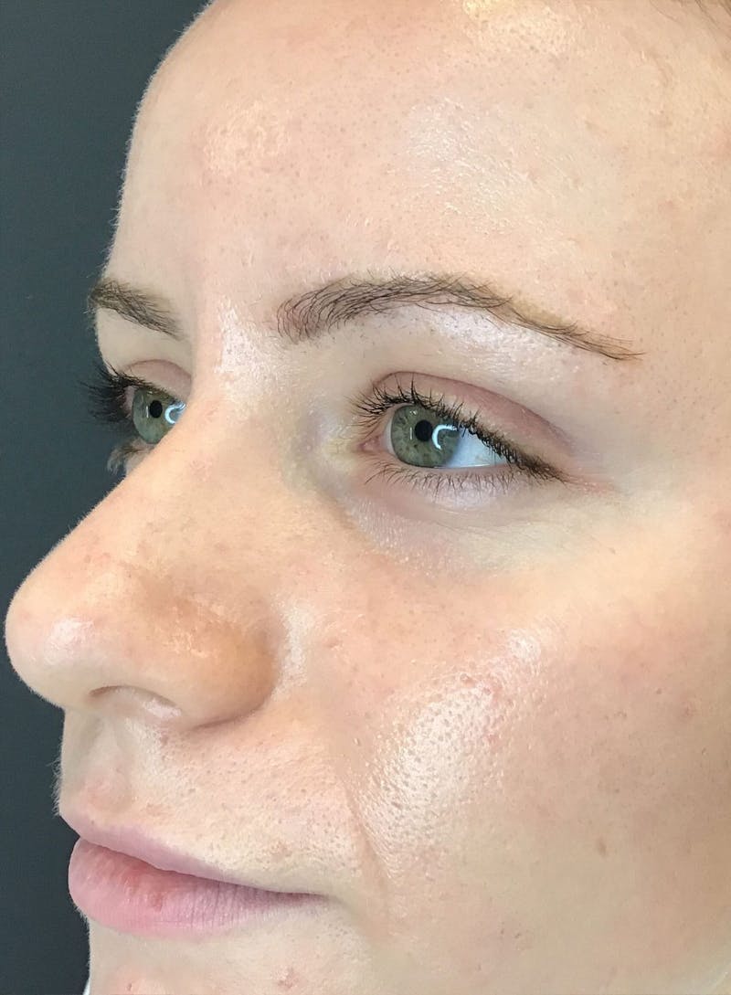 Dermal Fillers Before & After Gallery - Patient 210414 - Image 3