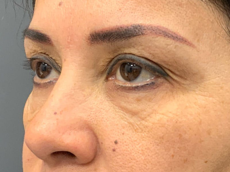 Blepharoplasty Before & After Gallery - Patient 341667 - Image 3
