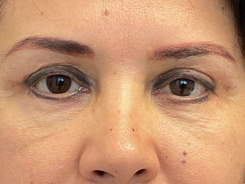 Blepharoplasty Before & After Gallery - Patient 341667 - Image 2