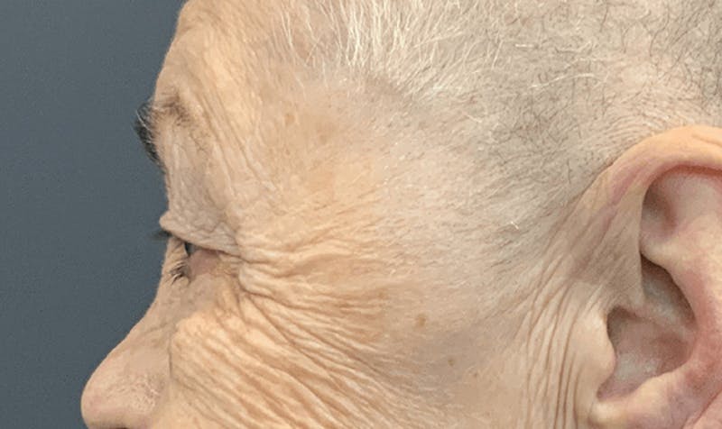 Blepharoplasty Before & After Gallery - Patient 355328 - Image 9