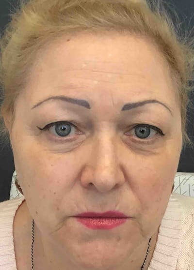 Dermal Fillers Before & After Gallery - Patient 100588 - Image 2